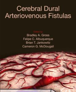 Cerebral Dural Arteriovenous Fistulas eBook