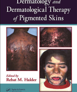 Dermatology and Dermatological Therapy of Pigmented Skins eBook