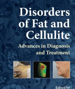 Disorders of Fat and Cellulite: Advances in Diagnosis and Treatment eBook