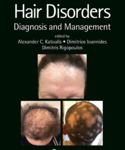 Hair Disorders: Diagnosis and Management eBook