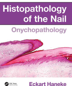 Histopathology of the Nail: Onychopathology eBook