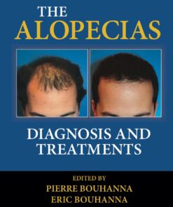 The Alopecias: Diagnosis and Treatments eBook