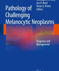 Pathology of Challenging Melanocytic Neoplasms: Diagnosis and Management eBook