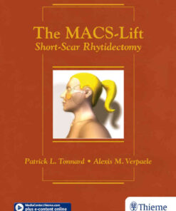 The MACS-Lift: Short-Scar Rhytidectomy eBook