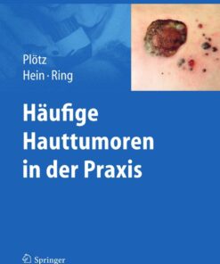 Häufige Hauttumoren in der Praxis eBook