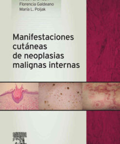 Manifestaciones cutáneas de neoplasias malignas internas eBook